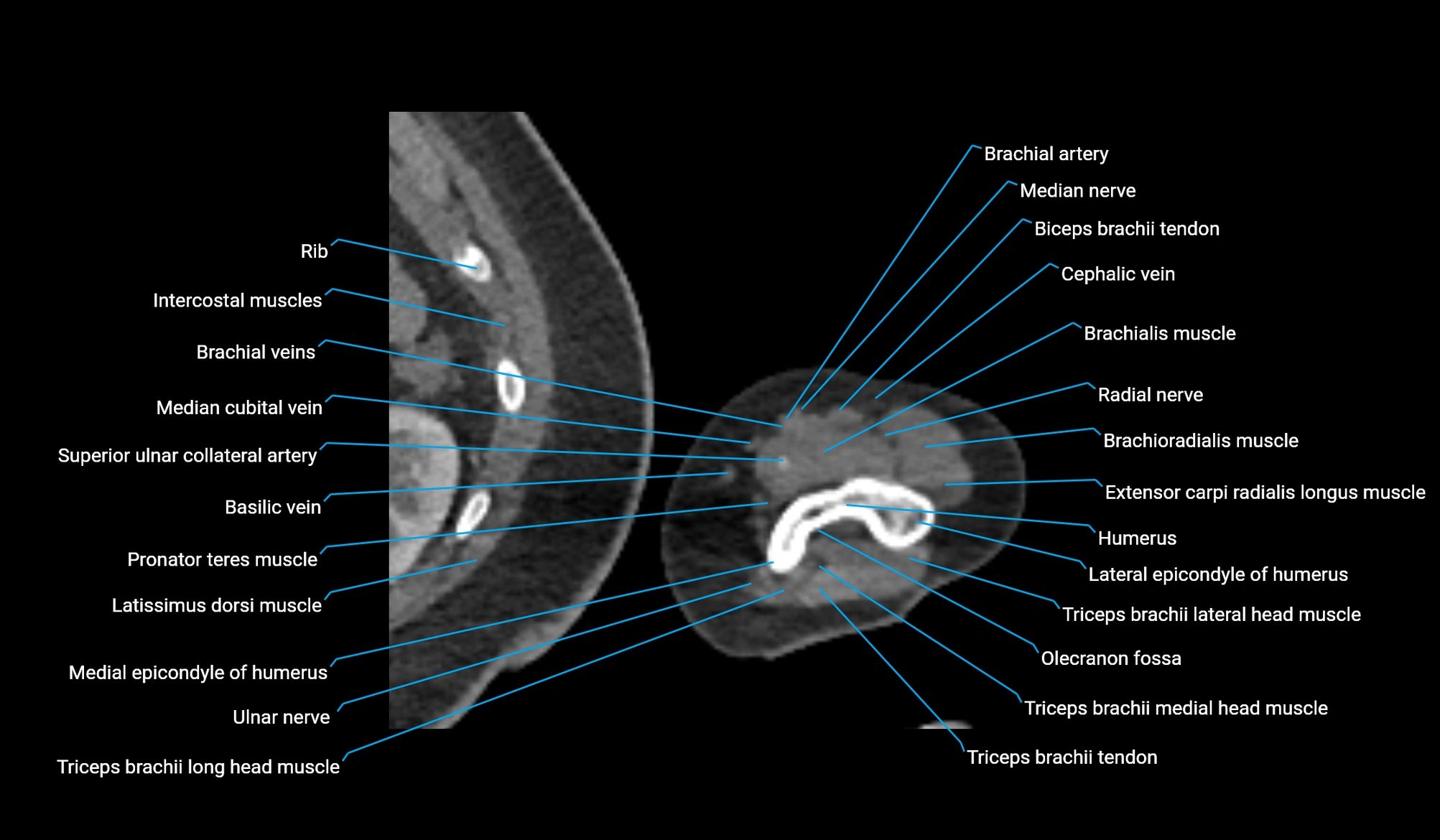 CT upper arm axial  cross sectional anatomy labelled radiology image -00370.webp